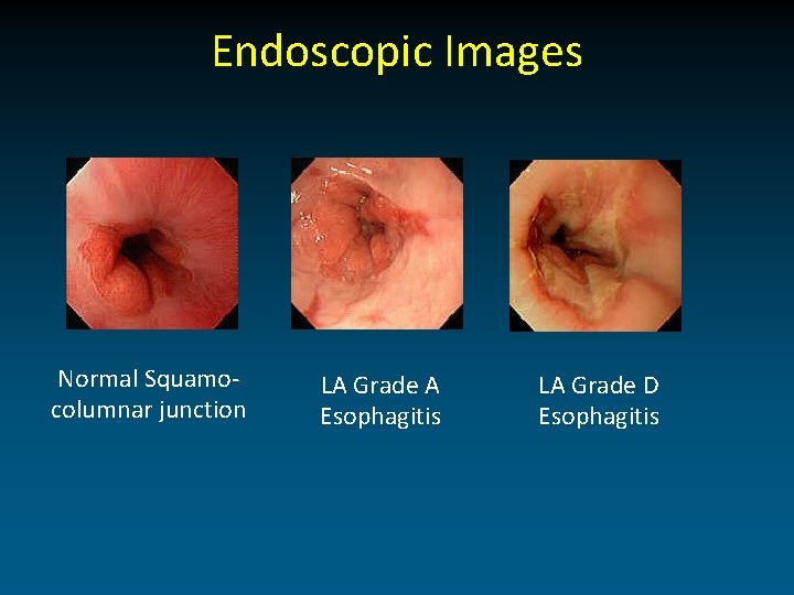 Endoscopic Images Normal Squamocolumnar junction LA Grade A Esophagitis LA Grade D Esophagitis 