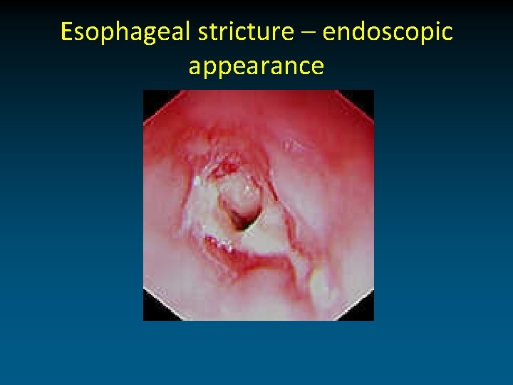 Esophageal stricture – endoscopic appearance 