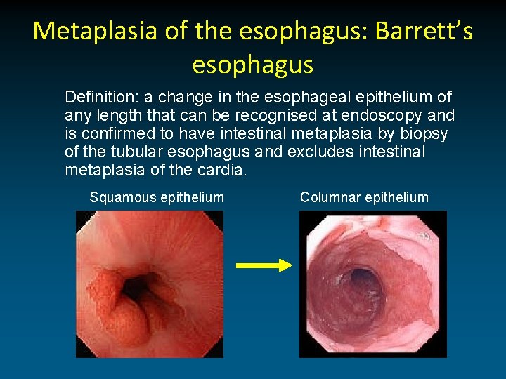 Metaplasia of the esophagus: Barrett’s esophagus Definition: a change in the esophageal epithelium of