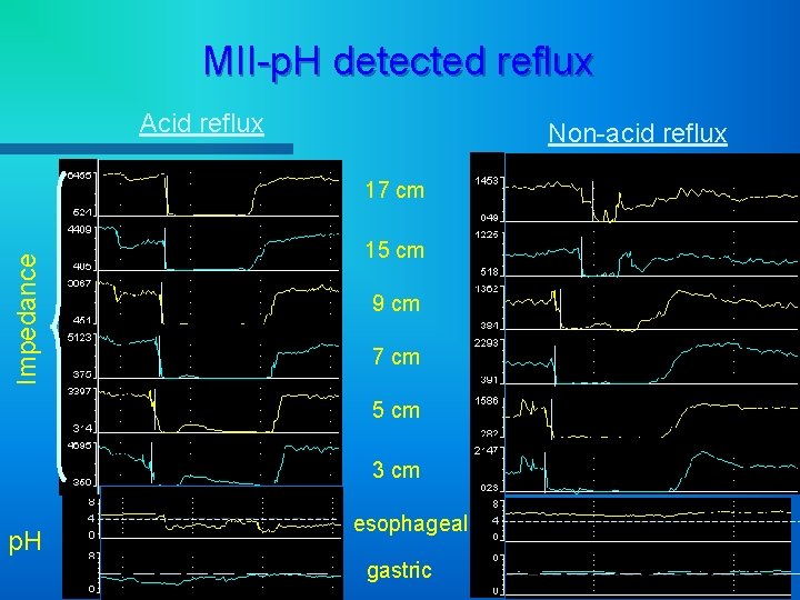 MII-p. H detected reflux Acid reflux Non-acid reflux 17 cm Impedance 15 cm 9