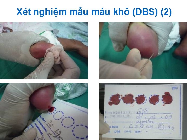 Xét nghiệm mẫu máu khô (DBS) (2) 19 