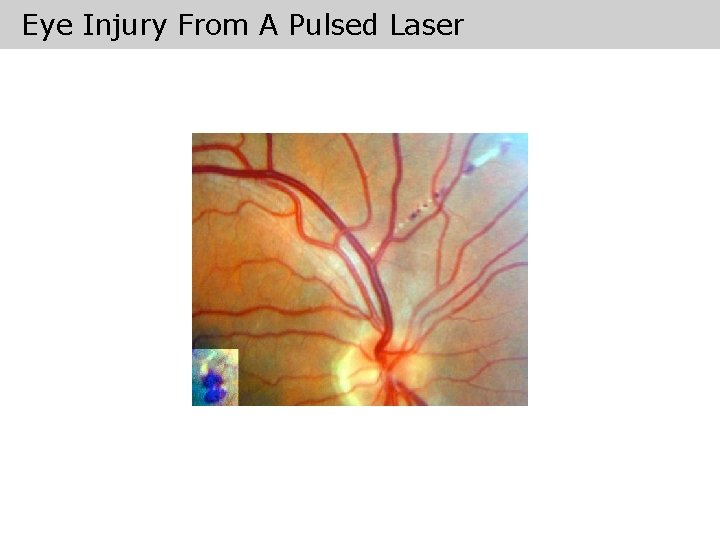 Eye Injury From A Pulsed Laser 
