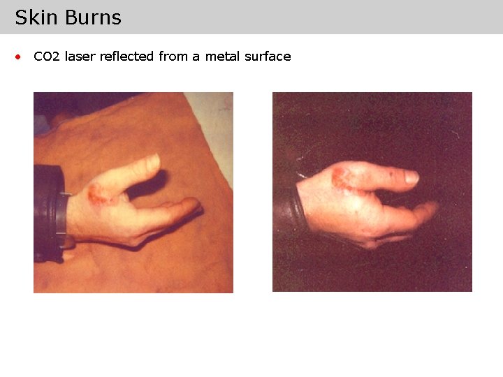 Skin Burns • CO 2 laser reflected from a metal surface 