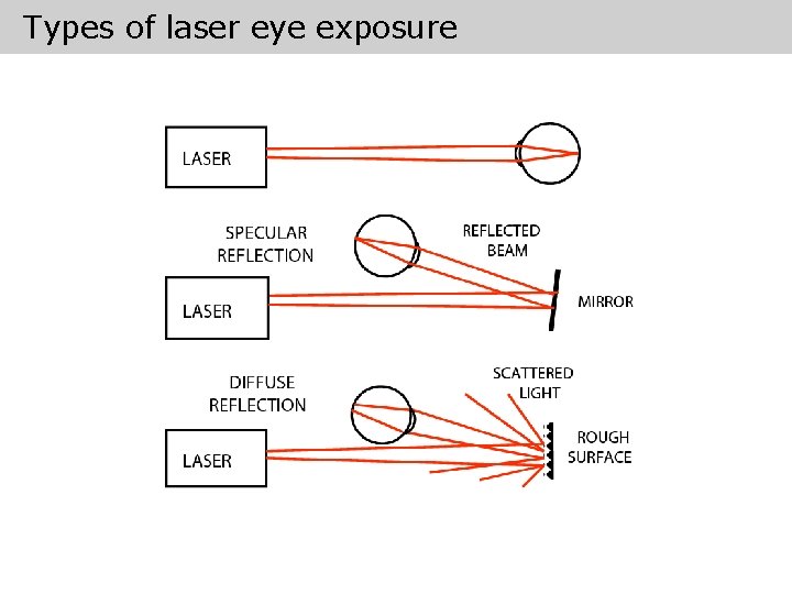 Types of laser eye exposure 