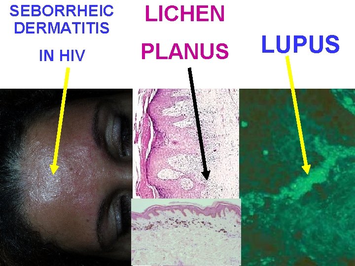 SEBORRHEIC DERMATITIS LICHEN IN HIV PLANUS LUPUS 