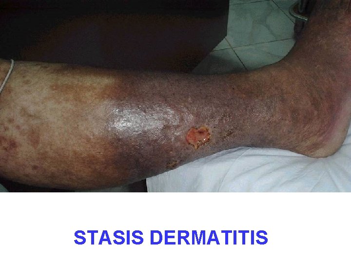 STASIS DERMATITIS STASIS DERMATITIS