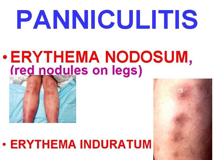 PANNICULITIS • ERYTHEMA NODOSUM, (red nodules on legs) • ERYTHEMA INDURATUM 