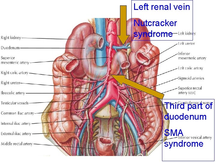Left renal vein Nutcracker syndrome Third part of duodenum SMA syndrome Left renal vein Nutcracker syndrome Third part of duodenum SMA syndrome