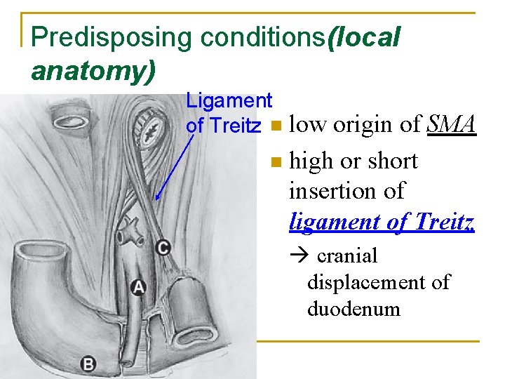 Predisposing conditions(local anatomy) Ligament of Treitz n low origin of SMA n high or