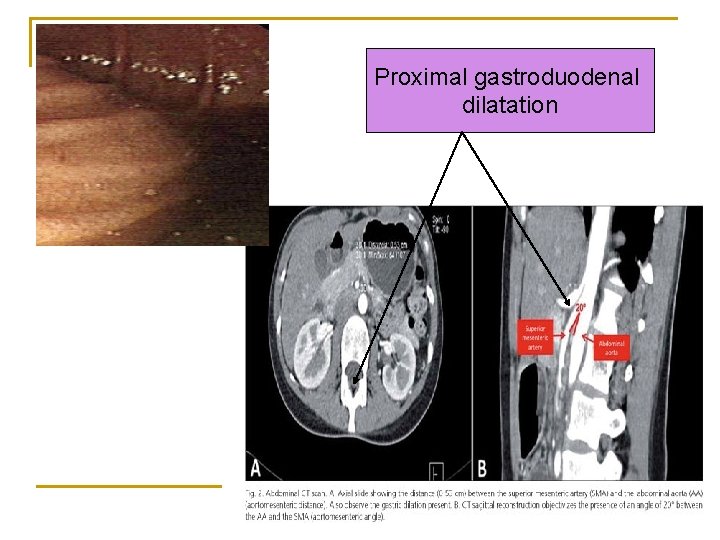 Proximal gastroduodenal dilatation 