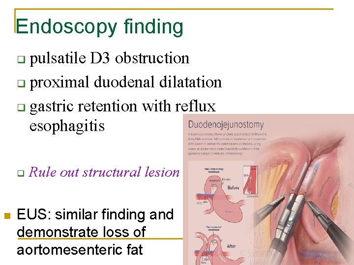 Endoscopy finding pulsatile D 3 obstruction q proximal duodenal dilatation q gastric retention with