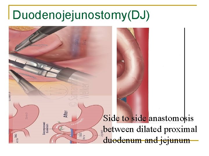 Duodenojejunostomy(DJ) Side to side anastomosis between dilated proximal duodenum and jejunum 