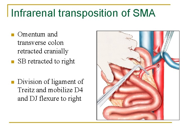 Infrarenal transposition of SMA n n n Omentum and transverse colon retracted cranially SB