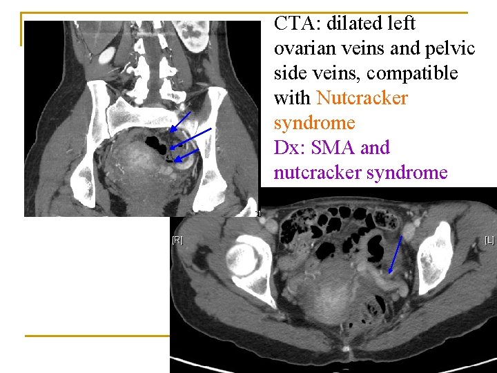 CTA: dilated left ovarian veins and pelvic side veins, compatible with Nutcracker syndrome Dx: