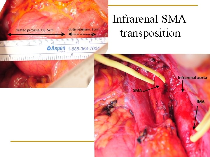 Infrarenal SMA transposition 