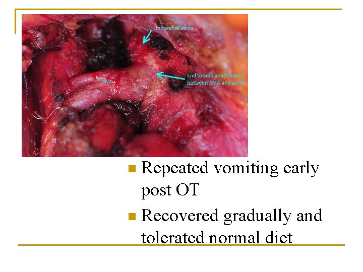 Repeated vomiting early post OT n Recovered gradually and tolerated normal diet n Repeated vomiting early post OT n Recovered gradually and tolerated normal diet n