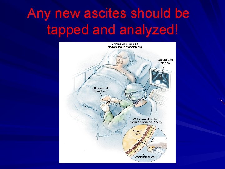 Any new ascites should be tapped analyzed! 