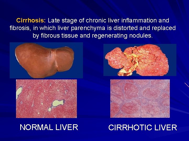 Cirrhosis: Late stage of chronic liver inflammation and fibrosis, in which liver parenchyma is