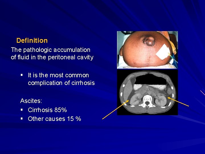 Definition The pathologic accumulation of fluid in the peritoneal cavity § It is the