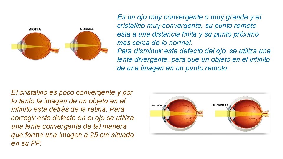 Es un ojo muy convergente o muy grande y el cristalino muy convergente, su