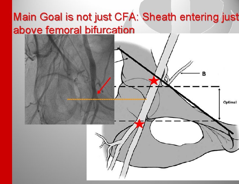 Main Goal is not just CFA: Sheath entering just above femoral bifurcation 