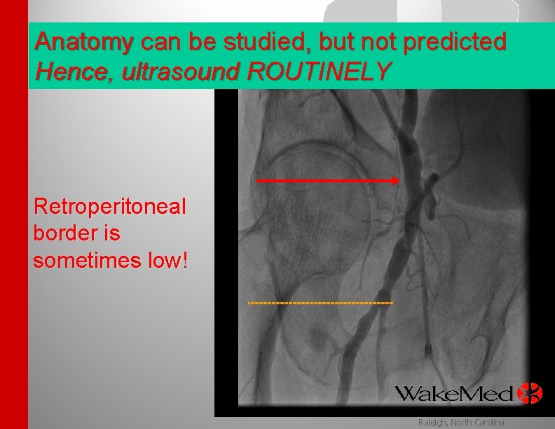 Anatomy can be studied, but not predicted Hence, ultrasound ROUTINELY Retroperitoneal border is sometimes