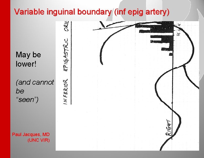 Variable inguinal boundary (inf epig artery) May be lower! (and cannot be “seen”) Paul