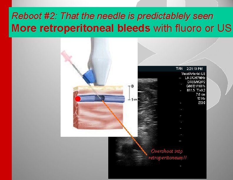 Reboot #2: That the needle is predictablely seen More retroperitoneal bleeds with fluoro or