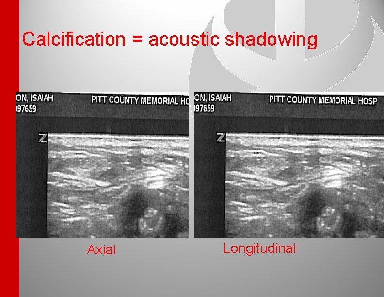 Calcification = acoustic shadowing Axial Longitudinal 