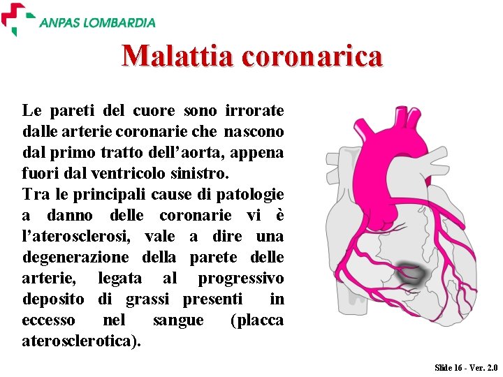 Malattia coronarica Le pareti del cuore sono irrorate dalle arterie coronarie che nascono dal Malattia coronarica Le pareti del cuore sono irrorate dalle arterie coronarie che nascono dal