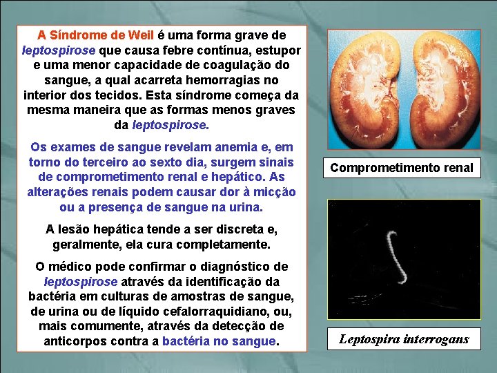 A Síndrome de Weil é uma forma grave de leptospirose que causa febre contínua,