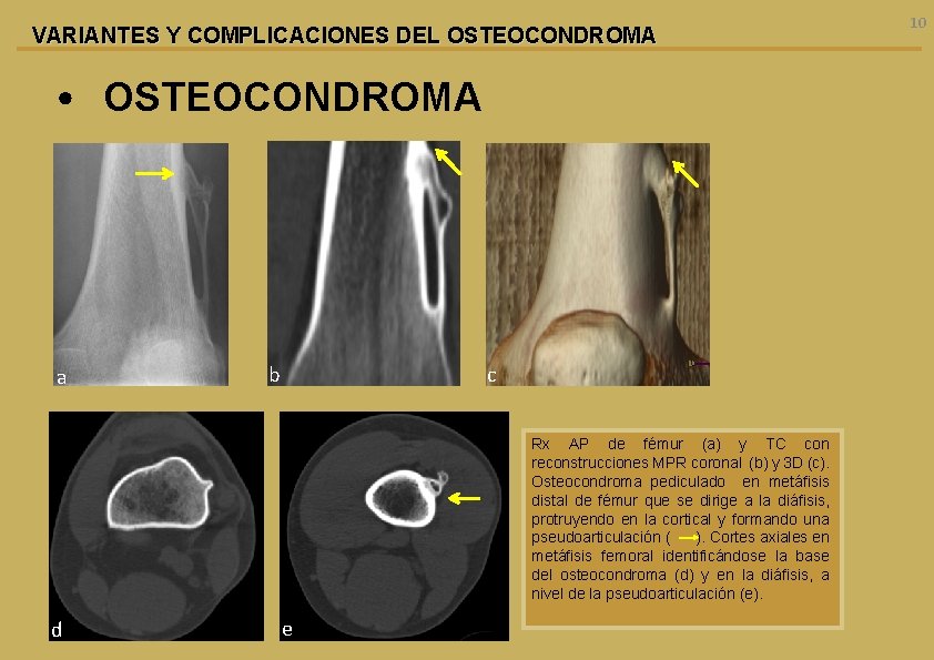 VARIANTES Y COMPLICACIONES DEL OSTEOCONDROMA • OSTEOCONDROMA a b c Rx AP de fémur