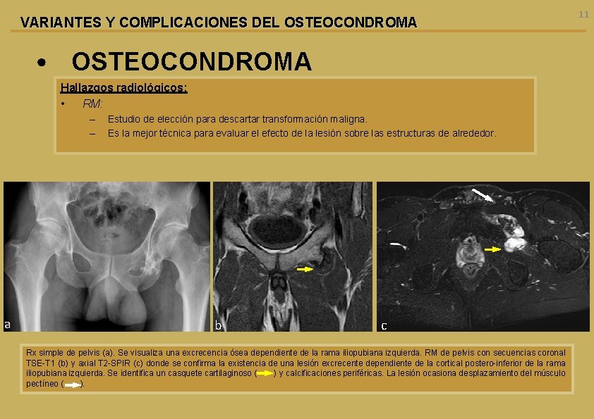 VARIANTES Y COMPLICACIONES DEL OSTEOCONDROMA • OSTEOCONDROMA Hallazgos radiológicos: • RM: – – a