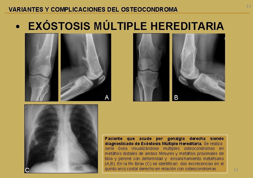 13 VARIANTES Y COMPLICACIONES DEL OSTEOCONDROMA • EXÓSTOSIS MÚLTIPLE HEREDITARIA A C B Paciente