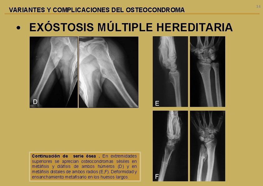 VARIANTES Y COMPLICACIONES DEL OSTEOCONDROMA • EXÓSTOSIS MÚLTIPLE HEREDITARIA D E Continuación de serie