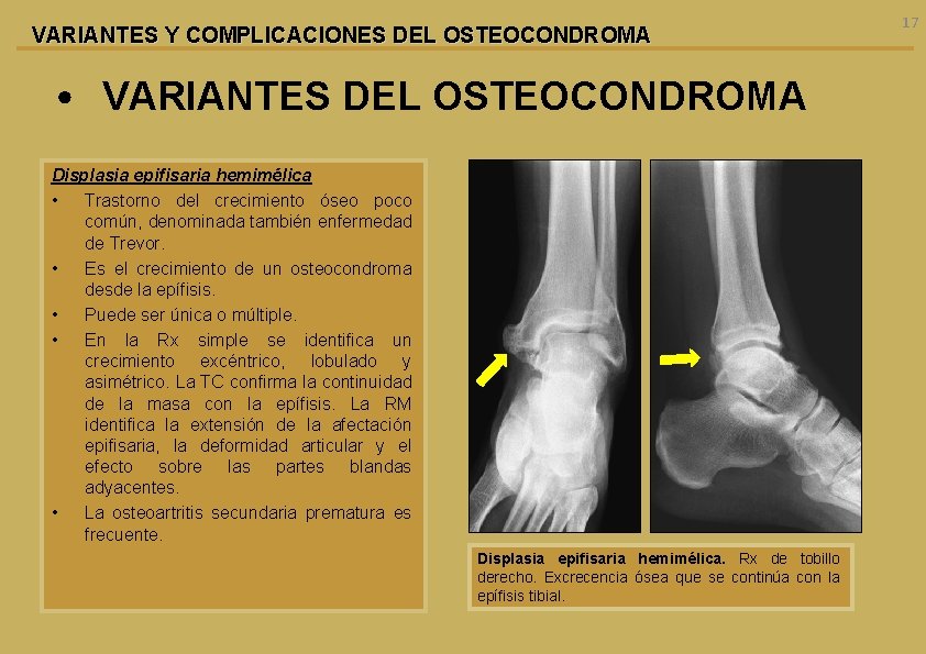 VARIANTES Y COMPLICACIONES DEL OSTEOCONDROMA • VARIANTES DEL OSTEOCONDROMA Displasia epifisaria hemimélica • Trastorno