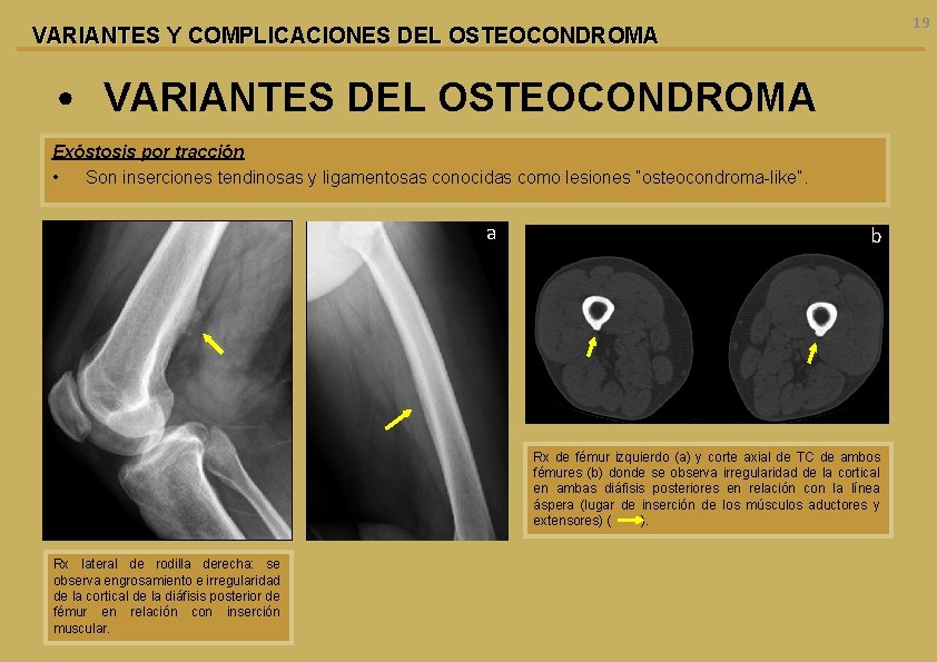 19 VARIANTES Y COMPLICACIONES DEL OSTEOCONDROMA • VARIANTES DEL OSTEOCONDROMA Exóstosis por tracción •