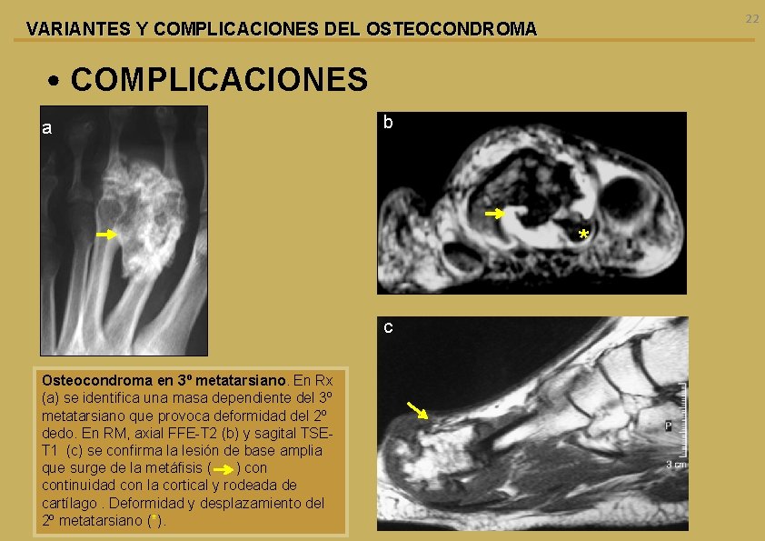 22 VARIANTES Y COMPLICACIONES DEL OSTEOCONDROMA • COMPLICACIONES a b * c Osteocondroma en