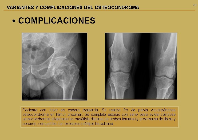 VARIANTES Y COMPLICACIONES DEL OSTEOCONDROMA • COMPLICACIONES Paciente con dolor en cadera izquierda. Se