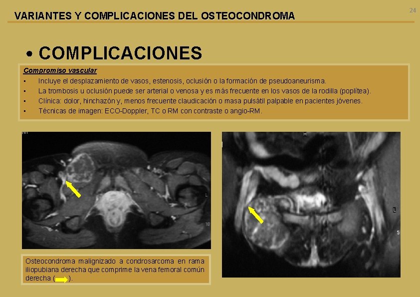 VARIANTES Y COMPLICACIONES DEL OSTEOCONDROMA • COMPLICACIONES Compromiso vascular • Incluye el desplazamiento de