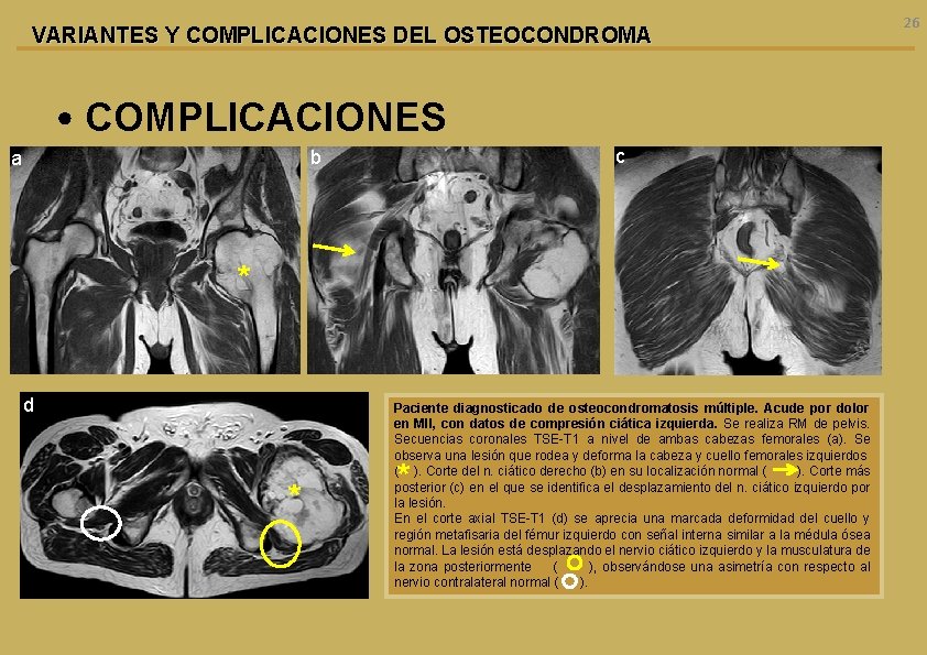 VARIANTES Y COMPLICACIONES DEL OSTEOCONDROMA • COMPLICACIONES c b a * d * Paciente