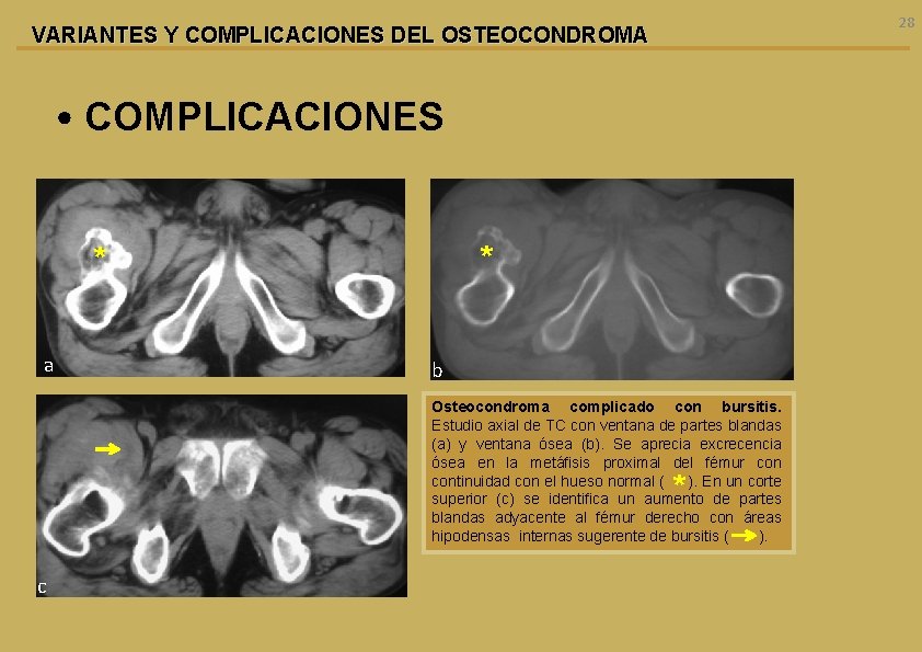 28 VARIANTES Y COMPLICACIONES DEL OSTEOCONDROMA • COMPLICACIONES * * a b Osteocondroma complicado