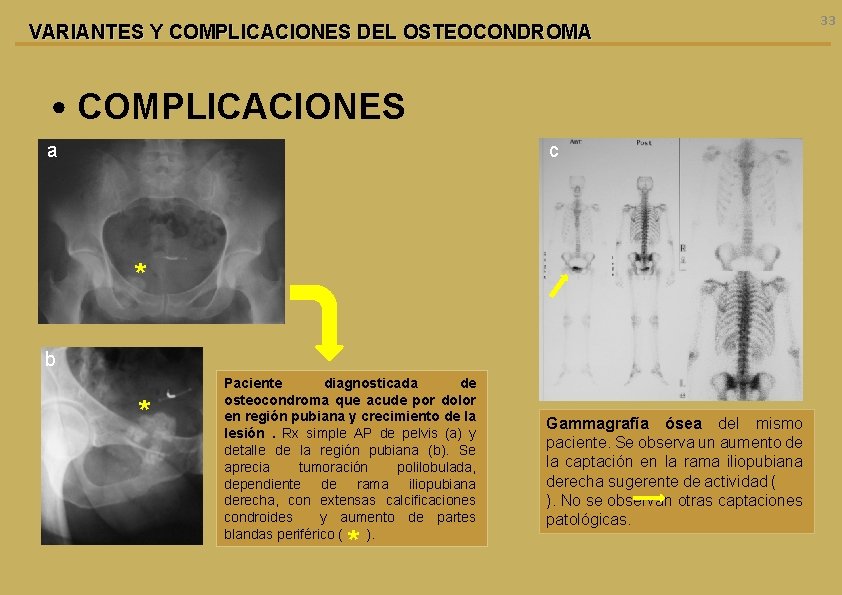 VARIANTES Y COMPLICACIONES DEL OSTEOCONDROMA • COMPLICACIONES a c * b * Paciente diagnosticada