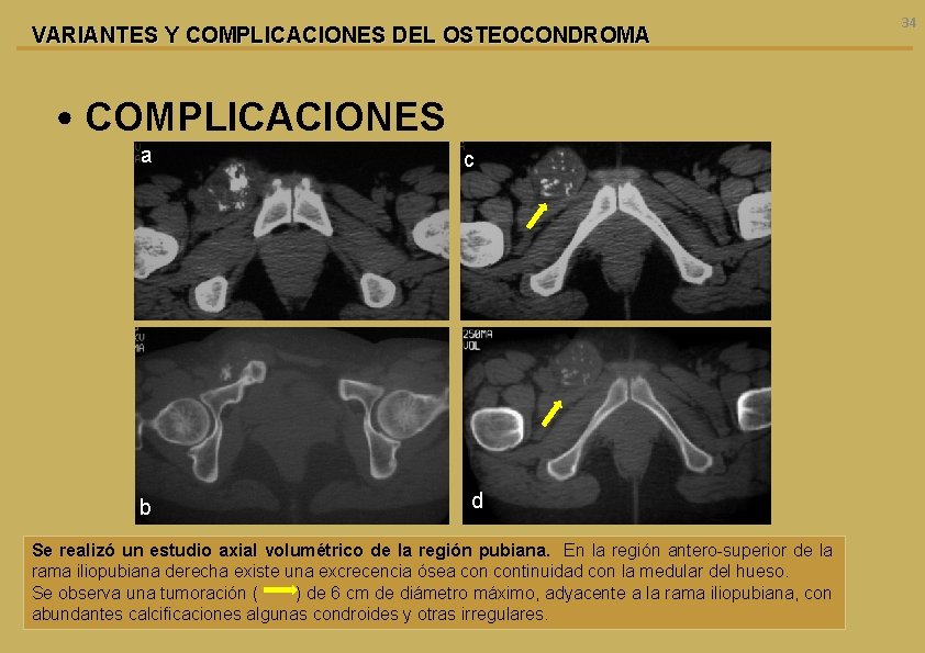 VARIANTES Y COMPLICACIONES DEL OSTEOCONDROMA • COMPLICACIONES a b c d Se realizó un