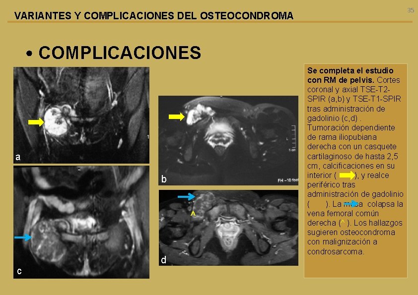 35 VARIANTES Y COMPLICACIONES DEL OSTEOCONDROMA • COMPLICACIONES a b ^ d c Se