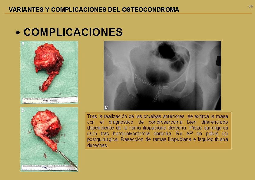 VARIANTES Y COMPLICACIONES DEL OSTEOCONDROMA • COMPLICACIONES a b c Tras la realización de