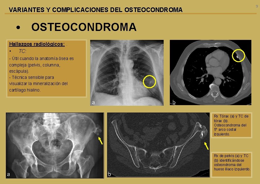 9 VARIANTES Y COMPLICACIONES DEL OSTEOCONDROMA • OSTEOCONDROMA Hallazgos radiológicos: . • TC: -