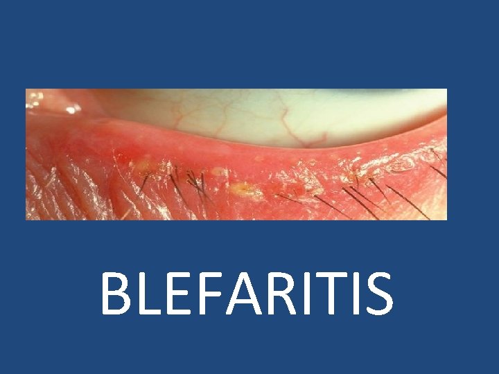 BLEFARITIS 