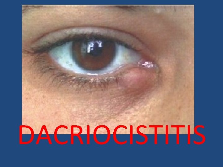 DACRIOCISTITIS 