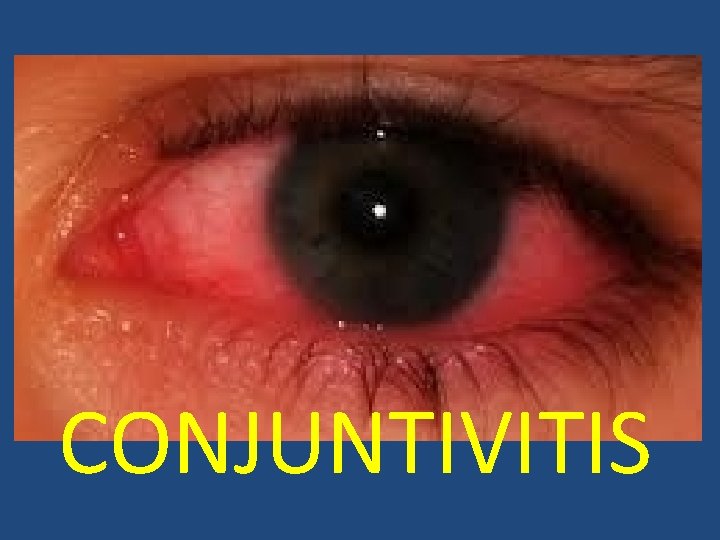 CONJUNTIVITIS 